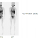 Tumorszintigraphie mit 123-J-mIBG